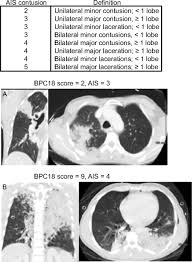 Image result for Pulmonary Contusion