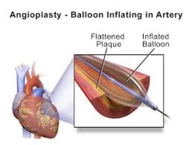 Angioplasty And Stenting product image