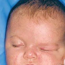 Somit kann das gehirn des babys ganz ungehindert wachsen. Korrektur Mit Kopfchen Gesundheit