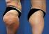 Cellulite On Legs Treatment