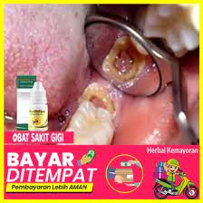 Obat sakit gigi di apotik paling ampuh. Jual Produk Obat Sakit Gigi Tetes Termurah Dan Terlengkap Agustus 2021 Bukalapak