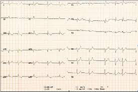 Ekg Fibrilathie Atriala Av 70 Min Bloc De Ramura Dreapta Incomplet Download Scientific Diagram