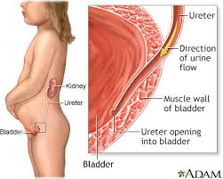 Reflux Nephropathy Information Mount Sinai New York