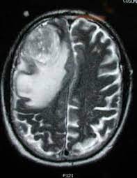 Imaging In Glioblastoma Multiforme Overview Radiography Computed Tomography