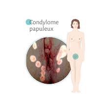 Résultat de recherche d'images pour "papilloma penis"