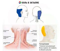 Kombinasi demam dan sakit belakang mungkin membimbangkan bagi pesakit, kerana ia adalah salah satu corak yang dicari oleh doktor apabila mengatasi gangguan berbahaya seperti kanser atau. Nyeri Di Bahagian Belakang Kepala Penyebab Rawatan Komprehensif Mengenai Kesihatan Di Ilive