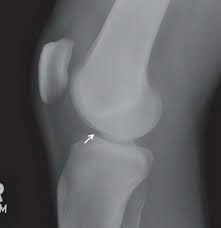 · last updated:march 8, 2021. Radiographic Signs Of Acl Tear Radiology Key