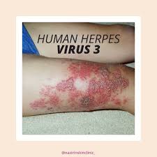 Image result for Varicella zoster on human skin