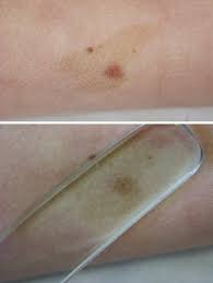 Image result for Diascopy