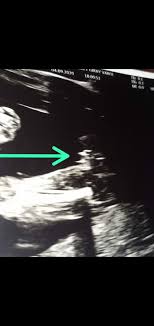 Kafasida sinirda doğmuştu 2.bebek kafasi normal büyüklükte dogdu. 18 Haftada Cinsiyet Degisirmi Diger