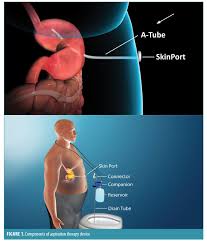 Since 2010 many insurance companies cover the costs of gastric sleeve surgery as a primary weight loss method, so make sure you check with your insurer. Aspiration Therapy An Emerging Endoscopic Device For Treatment Of Obesity Bariatric Times