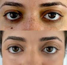 I'm no professional nora maya tattoo artist or an esthetician. 30 Before After Ideas Concealer Best Concealer Concealer Makeup