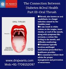 Image result for oral thrush symptoms roof of the mouth