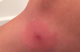 So what does a spider bite look like? Redback Spider Bite Symptoms Newcastle Pest Control