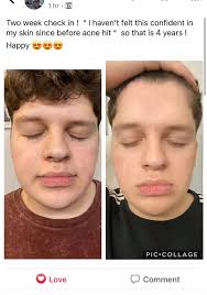 Michael Jackson's Acne Struggle and Its Impact