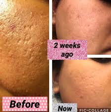 Leave acne to the experts — get acne care from a real provider with 1 short quiz. 24 Products To Help You Deal With Acne Scars
