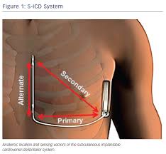 Implantable cardioverter defibrillator (icd) in children. The Subcutaneous Implantable Cardioverter Defibrillator New Insights And Expanding Populations Usc Journal