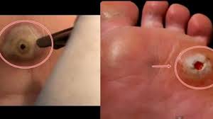 Doc, kaki saya dari sekolah rendah mendapat ketuat. Tak Susah Nak Hilangkan Ketuat Cuba Petua Ini Konfirm Hilang Dah Tau Ker