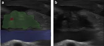 History & central and eastern europe, university of groningen (2014). Added Value Of Intra Operative Ultrasound To Determine The Resectability Of Locally Advanced Pancreatic Cancer Following Folfirinox Chemotherapy Image A Prospective Multicenter Study Hpb