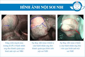 Hình ảnh ung thư hạ họng. Táº§m Soat Ung ThÆ° Vom MÅ©i Há»ng Háº¡ Há»ng Thanh Quáº£n Báº±ng Ná»™i Soi