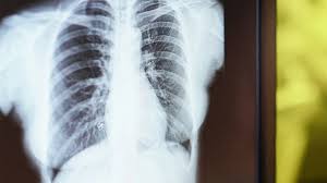 Image result for lung cancer xray
