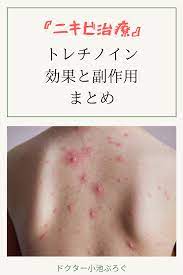 トレチノインの皮膚に対する5つの作用 ニキビ スキンケア 美肌 スキンケア