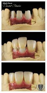 Accurate Dental Crown News Dentiste Dentalcrownsbeforeandafterbeautiful Dental Cosmetics Dental Crowns Dental Dentures