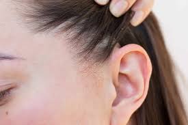 Adiós a la Dermatitis seborreica