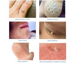 Image result for verrucae filiformes