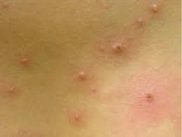 When it infects the lips, face, or genitals, hsv1 is often quite mild and more of a nuisance than anything else. Viral