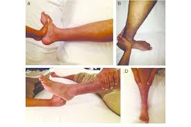 Image result for Ankle External Rotation Test