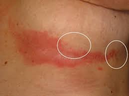 These areas are more susceptible to irritation and subsequent infection due to factors that promote skin breakdown such as moisture, friction, and exposure to bodily secretions such as sweat, urine, or feces. Intertrigo Altmeyers Encyclopedia Department Dermatology