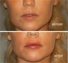 Non-Surgical Cosmetic Treatment