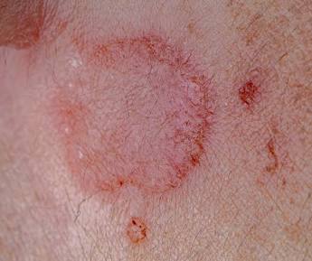 Close up of skin irritation and ringworm rash from jiu jitsu mat friction