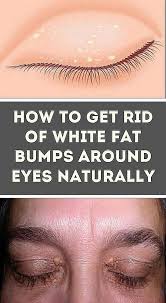 The Small White Bumps On Your Skin Which Usually Appear Around Your Nose Eyes Or Lips Are Known As Milia They Re Al Bumps Under Eyes Spots In Eyes Skin Bumps