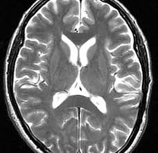 末期 癌 脳 転移 症状