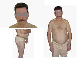 Check spelling or type a new query. Lipodystrophy The Metabolic Link Of Hiv Infection With Insulin Resistance Syndrome Intechopen