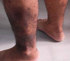 Hyperpigmentation is any discrete or blotchy brown discoloration and is most often caused by an injury to the skin. Leg Discoloration Specialist Webster Sugar Land Round Rock Katy San Antonio Tx Hamilton Vascular Vascular Vein Center