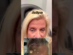 3 Forehead Osteomas Removed 6 Months Out with Close-up Views of Scars  #osteoma