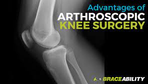 If a person does not have insurance and is going to pay from his own pocket and the cost is more than one can afford, the doctors give special. Benefits Of Arthroscopic Knee Surgery Cost Laparoscopic Recovery