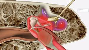 Image result for Bacterial Labyrinthitis