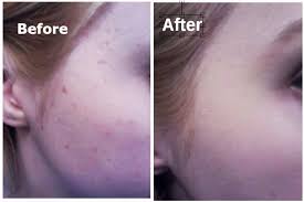 Banish blemishes on the daily with our acne control tea tree cleanser. One Reddit User Rid Herself Of Acne Scars With K Beauty And Microdermabrasion Allure