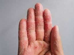 Neurodermitis an den händen neurodermitis kann verschiedene teile des körpers betreffen. Ekzem Am Finger Was Sind Die Ursachen Und Wie Wird Behandelt