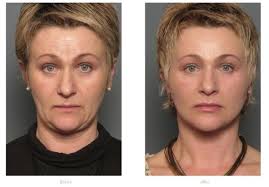 If you're concerned about sagging face and neck muscles as you age, jowl exercise may be able to help. How Can I Lift Sagging Jowls Stein Plastic Surgery