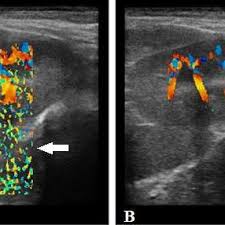 O doppler serve para avaliar o fluxo sanguíneo de vasos fetais e… importante método para o acompanhamento da vitalidade fetal em pacientes com doenças associadas à gestação, como diabetes, hipertensão arterial, trombofilia, etc. Pdf Ultrassonografia Doppler Colorido E Doppler Espectral Para O Estudo De Pequenos Fluxos