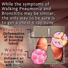 Check spelling or type a new query. 23 Best Walking Pneumonia Ideas Walking Pneumonia Pneumonia Mycoplasma