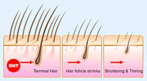 Women typically have a broadening of the part in their hair. Baldness Is A Real Problem