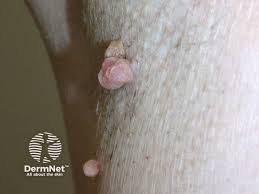 Image result for genital warts