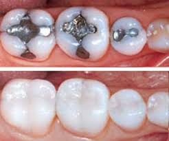 Tooth Colored Fillings | Services | SPS Dental | Kenosha, WI