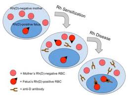 Image result for Rh Sensitization